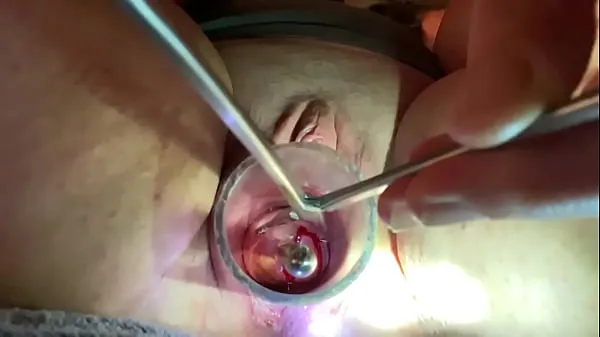 Hot Dilating to 9mm w Tenaculum and Hegar fine Movies